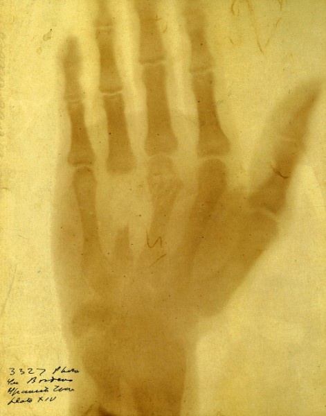 Fotografia rentgenowska przestrzelonej pociskiem dłoni, wojna hiszpańsko-amerykańska, 1898