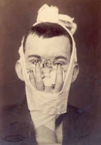 OG Mason - Odtworzenie nosa 2 (chirurg E. Hart)